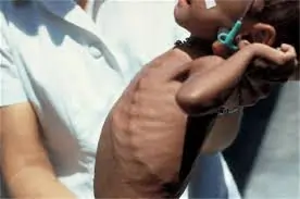 સ્કરવી (Scurvy)