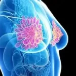 સ્તન કેન્સર (Breast Cancer)