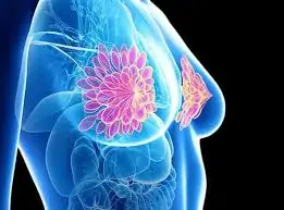સ્તન કેન્સર (Breast Cancer)