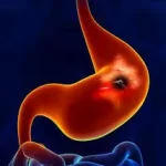 હોજરીનો સોજો (Gastritis)