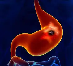 હોજરીનો સોજો (Gastritis)