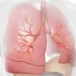 એમફિસીમા (Emphysema)
