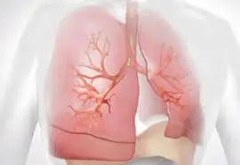 એમફિસીમા (Emphysema)