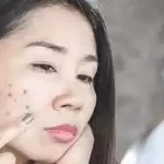 ખીલ (Pimples) અને કાળા ડાઘ મટાડવા માટેના દેશી ઉપચાર