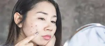 ખીલ (Pimples) અને કાળા ડાઘ મટાડવા માટેના દેશી ઉપચાર