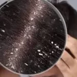 ડેન્ડ્રફ (ખોડો) કાયમ માટે દૂર કરવાના ઉપાયો