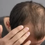 પુરુષોમાં નાની ઉંમરે વાળ ખરવા (Baldness/ટાલ) ના કારણો અને બચાવ