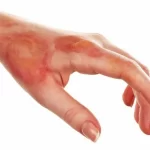 દાઝી જવા પર (Burn injuries) ટૂથપેસ્ટ કે બરફ લગાવવો જોઈએ કે નહિ?