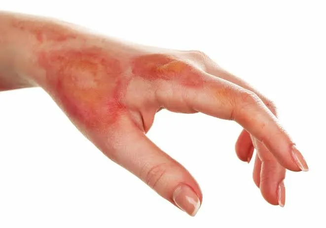 દાઝી જવા પર (Burn injuries) ટૂથપેસ્ટ કે બરફ લગાવવો જોઈએ કે નહિ?